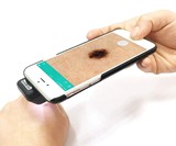 Skiary SK-3 Smartphone Dermatoscope