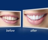 Teeth Whitening Accelerator