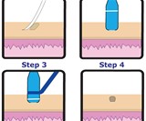 TagBand Skin Tag Remover