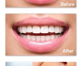 Teeth Whitening Pen