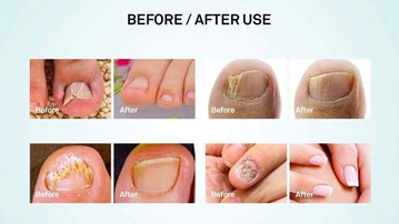 Nail Fungus Repair Pen Nail Fungus Repair Pen