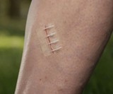 ZipStitch - Close Wounds Without Stitches