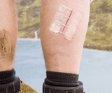 ZipStitch DIY Wound Closure Device