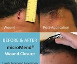 microMend Emergency Wound Closures