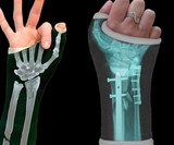 Bone Cast Tattoos
