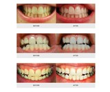 AuraGlow LED Teeth Whitening Kit