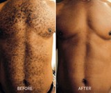 SmoothTech>Pro Male Hair Removal System