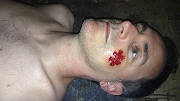 Jigsaw Puzzle Piece Prosthetic Jigsaw Puzzle Piece Prosthetic