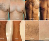 SmoothTech>Pro Male Hair Removal System