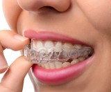 Byte At-Home Teeth Straightening System