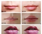 Electric Lip Plumper