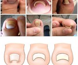 Ingrown Toenail Correction Tool