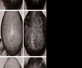 iRestore Laser Hair Growth System
