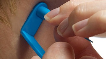 Micro TagBand Skin Tag Remover Micro TagBand Skin Tag Remover