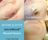 microMend Emergency Wound Closures