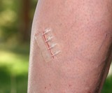ZipStitch Wound Closure Device