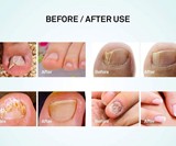 Nail Fungus Repair Pen